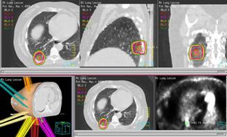 Stereotactic Radiotherapy